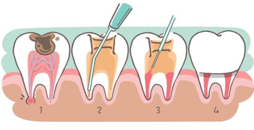 ضرورة علاج جذور الاسنان