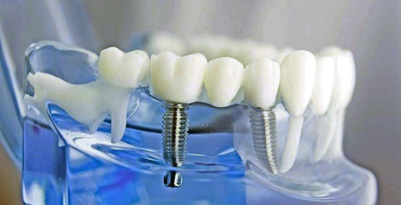 احدث ابتكارات زراعة الأسنان واسعارها