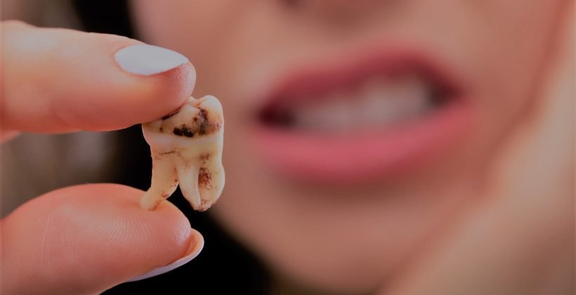 علاج تسوس الاسنان واسعاره في مصر